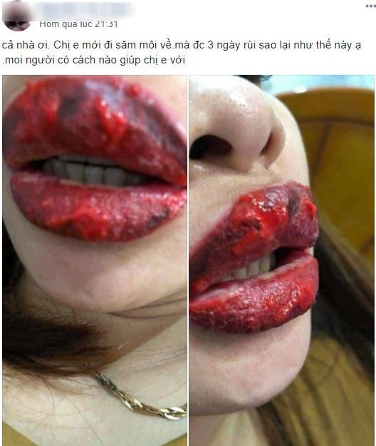 Phun xăm hỏng, đôi môi cô gái sưng vù cứ nói 1 câu lại ứa máu đau đớn ảnh 3 Rùng mình đôi môi cô gái trẻ sưng như 2 miếng thịt bò khô vì phun xăm hỏng, cứ nói 1 câu lại ứa máu đau đớn-3