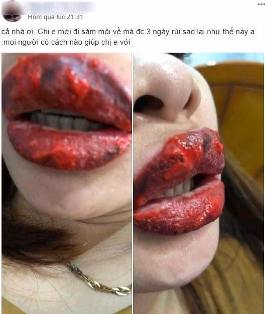 Rùng mình đôi môi cô gái trẻ sưng như 2 miếng thịt bò khô vì phun xăm hỏng, cứ nói 1 câu lại ứa máu đau đớn-3