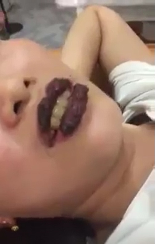 Phun xăm hỏng, đôi môi cô gái sưng vù cứ nói 1 câu lại ứa máu đau đớn ảnh 1 Rùng mình đôi môi cô gái trẻ sưng như 2 miếng thịt bò khô vì phun xăm hỏng, cứ nói 1 câu lại ứa máu đau đớn-1