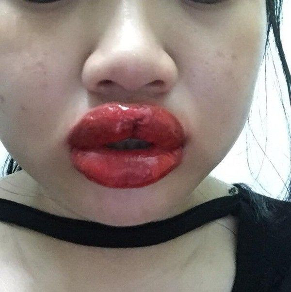 Phun xăm hỏng, đôi môi cô gái sưng vù cứ nói 1 câu lại ứa máu đau đớn ảnh 6 Rùng mình đôi môi cô gái trẻ sưng như 2 miếng thịt bò khô vì phun xăm hỏng, cứ nói 1 câu lại ứa máu đau đớn-6