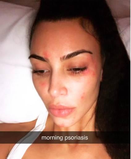 Kim Kardashian trầm cảm vì bệnh lupus ảnh 1