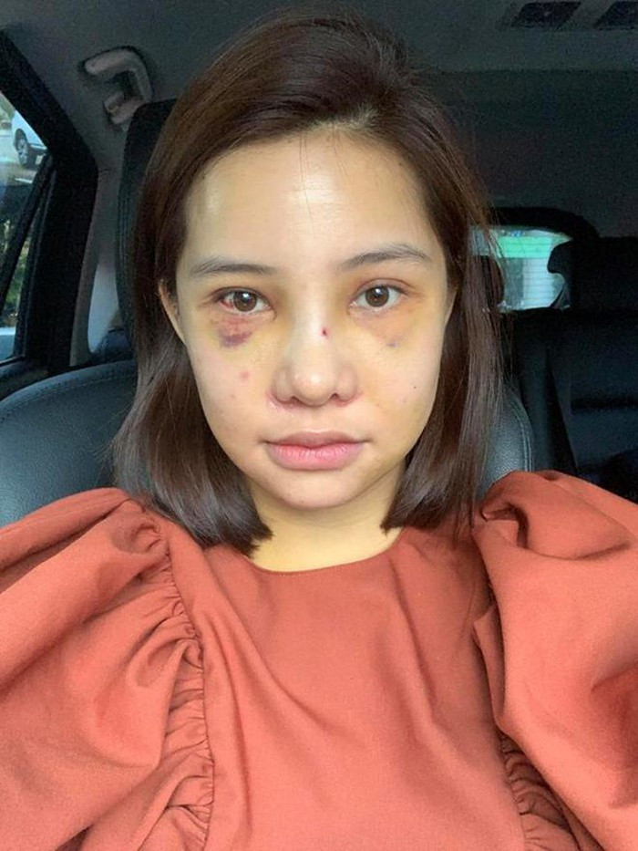 Lưu Đê Ly công khai phẫu thuật thẩm mỹ toàn bộ gương mặt ảnh 2 Lưu Đê Ly công khai phẫu thuật thẩm mỹ toàn bộ gương mặt ảnh 2