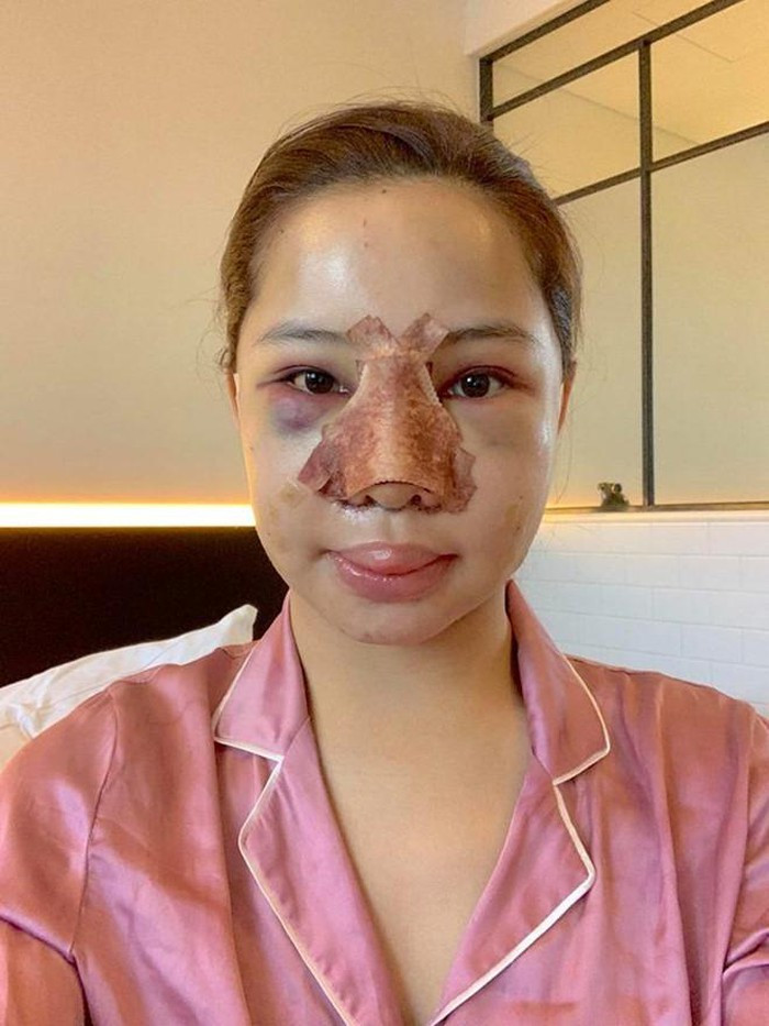 Lưu Đê Ly công khai phẫu thuật thẩm mỹ toàn bộ gương mặt ảnh 1 Lưu Đê Ly công khai phẫu thuật thẩm mỹ toàn bộ gương mặt ảnh 1