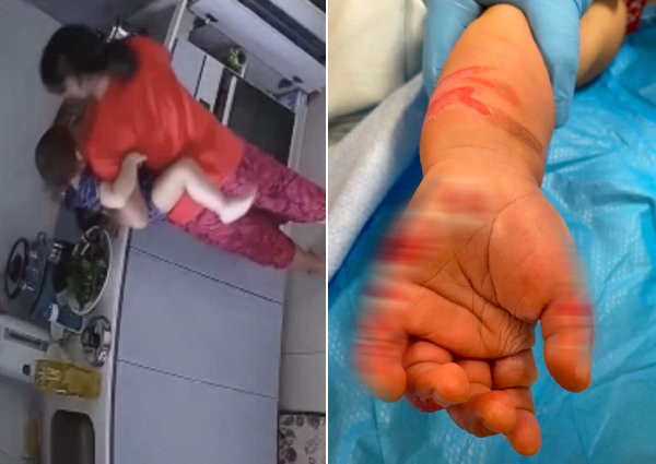 Người giúp việc nhúng tay bé gái 16 tháng tuổi vào nước sôi với lý do khó tha thứ