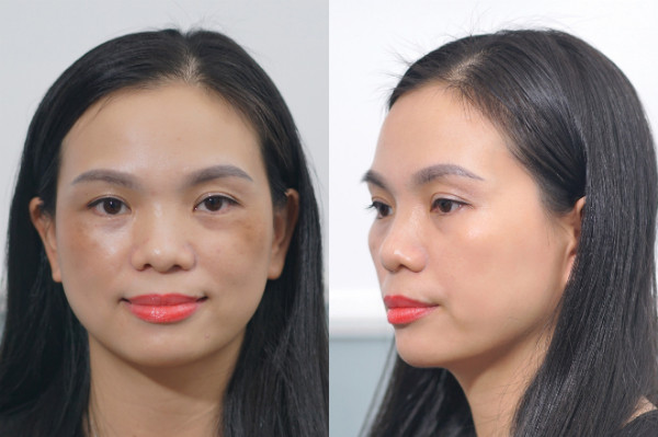 CẨN THẬN KHI ĐIỀU TRỊ NÁM BẰNG LASER (xin bài edit) - 2