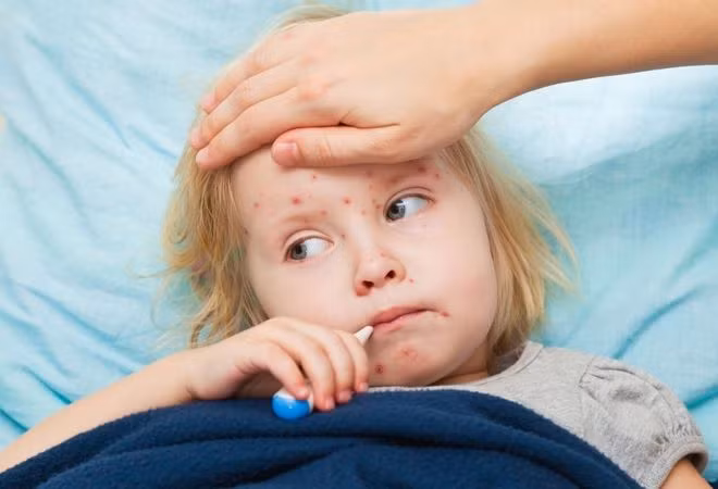 Sức khỏe - Những hiểm họa khôn lường khi cha mẹ không tiêm phòng sởi cho trẻ