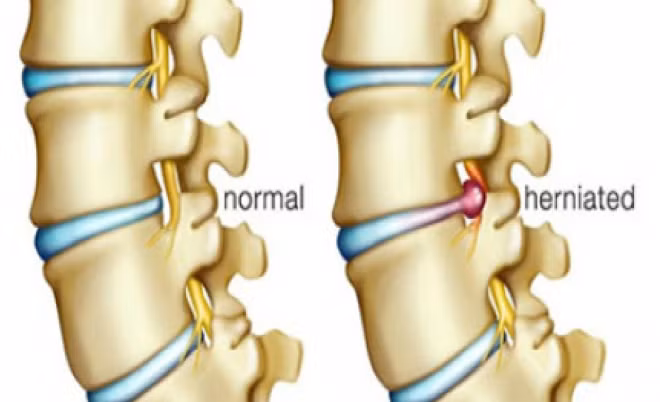 Đĩa đệm bình thường (bên trái) và đĩa đệm bị thoát vị (bên phải). Ảnh: orthoadc