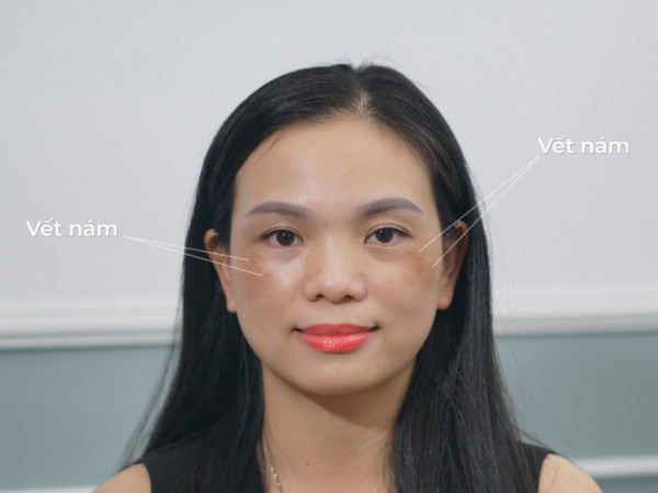 CẨN THẬN KHI ĐIỀU TRỊ NÁM BẰNG LASER (xin bài edit)