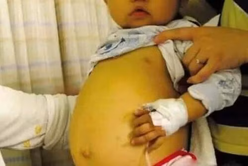 Bé 3 tuổi bụng đầy mủ, thủng ruột vì bà hay cho ăn thứ mà trẻ em nào cũng thích