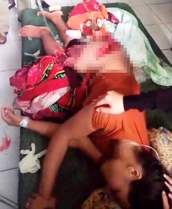  Chị T. bị thương nặng do bị cánh quạt thuyền chém phải trong lúc cứu con trai. 