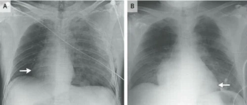 Kết quả chụp và CT ngực cho thấy tim bệnh nhân đã xoay 90 độ về bên phải. Ảnh: Live Science.