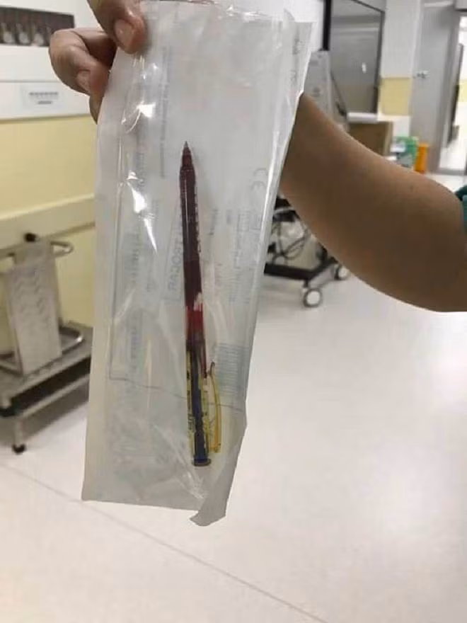 Vấp ngã khi cầm bút chơi đùa, bé gái 4 tuổi suýt chết vì bút đâm thấu ngực - 2