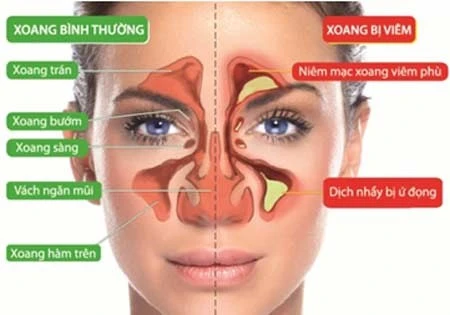 Ứng phó với chứng ngạt tắc mũi mùa đông - xuân