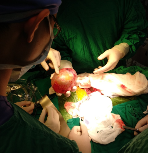 Bác sĩ phẫu thuật mang khối u thai ra ngoài. Ảnh bệnh viện cung cấp. Bác sĩ phẫu thuật mang khối u thai ra ngoài. Ảnh bệnh viện cung cấp.