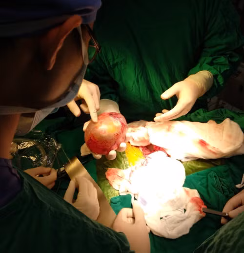 Bác sĩ phẫu thuật mang khối u thai ra ngoài. Ảnh bệnh viện cung cấp.