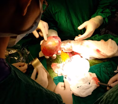 Bé trai 4 tháng tuổi bụng to bất thường, đi khám cả nhà giật mình phát hiện vật thể lạ