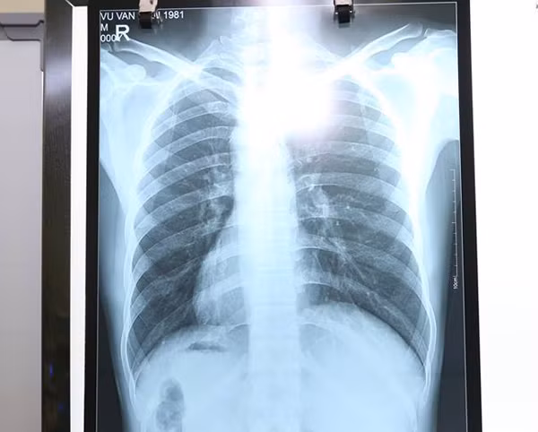 Người đàn ông Hà Nội có tim và dạ dày lộn ngược khiến bác sĩ kinh ngạc