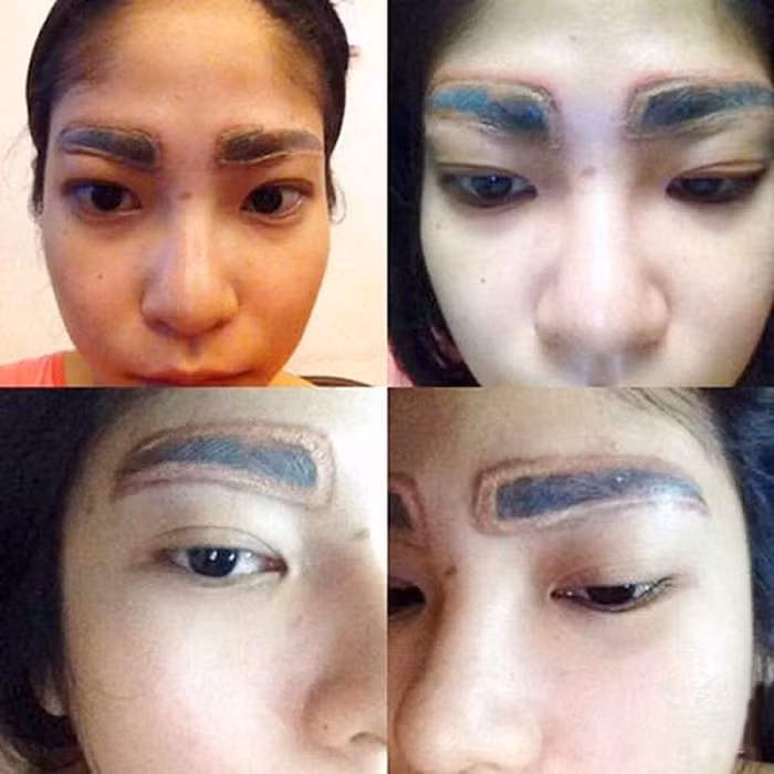 Những vết xăm trở thành sẹo trên lông mày.