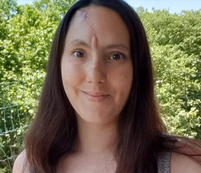 Làm đẹp không phòng bị cẩn thận, cô gái phải cắt bỏ một phần mũi - 5