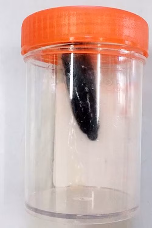 Con đỉa trong đường thở bé gái sau khi được nội noi. Ảnh: Bệnh viện cung cấp.