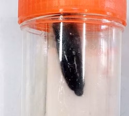 Con đỉa dài 5 cm sống trong phế quản bé gái