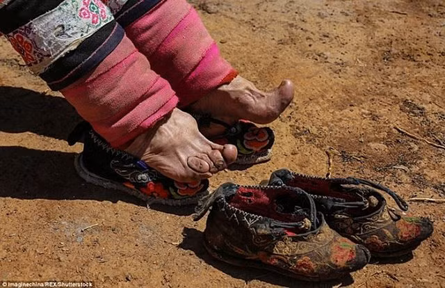 Tục Bó chân gót sen của Trung Quốc xưa: Hình ảnh những đôi chân rỉ máu và biến dạng khiến phụ nữ thời nay phải nín thở nổi da gà - Hình 7