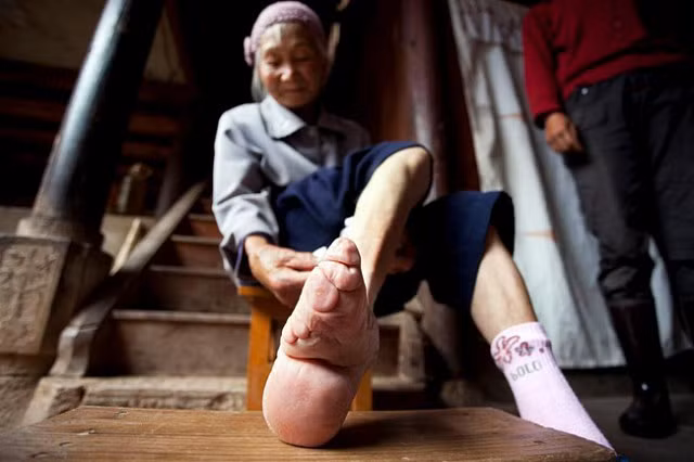 Tục Bó chân gót sen của Trung Quốc xưa: Hình ảnh những đôi chân rỉ máu và biến dạng khiến phụ nữ thời nay phải nín thở nổi da gà - Hình 18