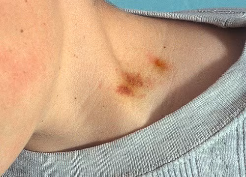 Tím hết cả mình mẩy - Hình 1