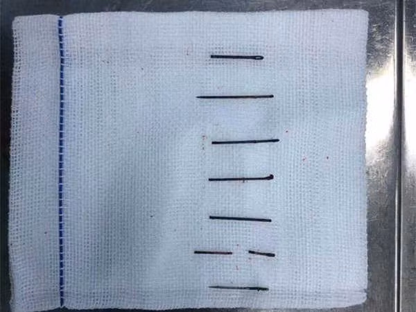 Cuộc phẫu thuật diễn ra trong vòng 4 giờ đồng hồ. Tất cả 8 chiếc kim đã được lấy ra. 