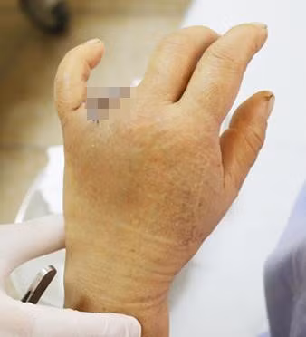 Mắc nhẫn vào cửa ôtô, một phụ nữ mất ngón tay