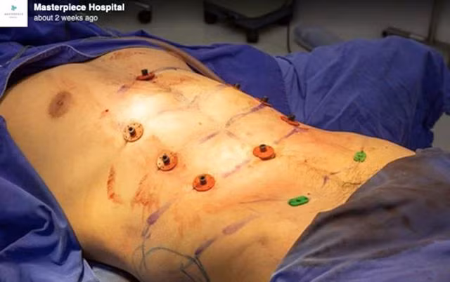 Dịch vụ phẫu thuật cơ bụng 6 múi lên ngôi - 2