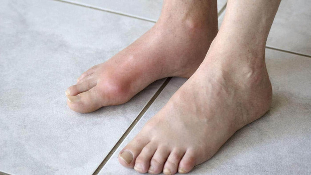 Cậu bé 13 tuổi mắc bệnh gout, nguyên nhân đến từ thức uống mà hầu hết đứa trẻ nào cũng ưa thích - Ảnh 1. Cậu bé 13 tuổi mắc bệnh gout, nguyên nhân đến từ thức uống mà hầu hết đứa trẻ nào cũng ưa thích-1