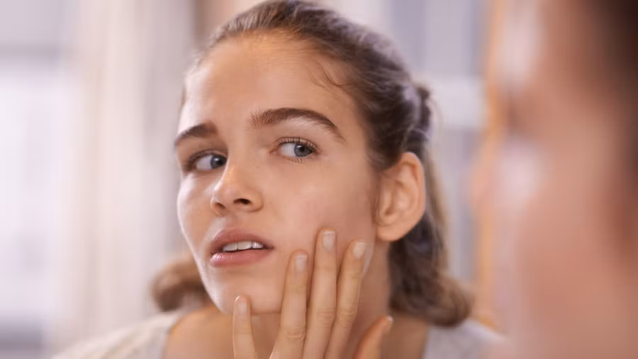 Đang bị mụn cần tránh làm 5 việc này để không làm tình trạng mụn thêm tồi tệ-2