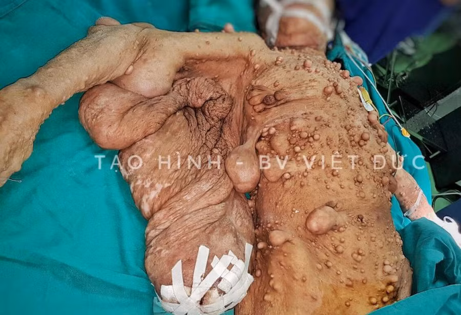 Kinh hoàng người phụ nữ mọc u toàn thân chi chít như quả sung - Ảnh 2.