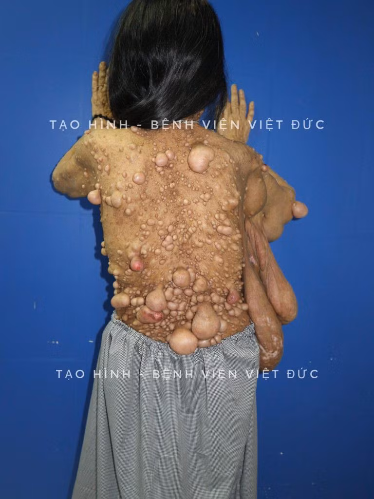 Kinh hoàng người phụ nữ mọc u toàn thân chi chít như quả sung - Ảnh 1.