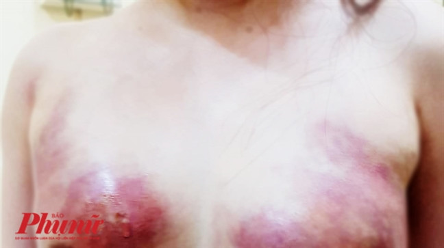 Tranh thủ làm đẹp cuối năm, 2 phụ nữ phải nhập viện để cắt bỏ phần ngực bị hoại tử Tranh thu lam dep cuoi nam, 2 phu nu phai nhap vien de cat bo phan nguc bi hoai tu