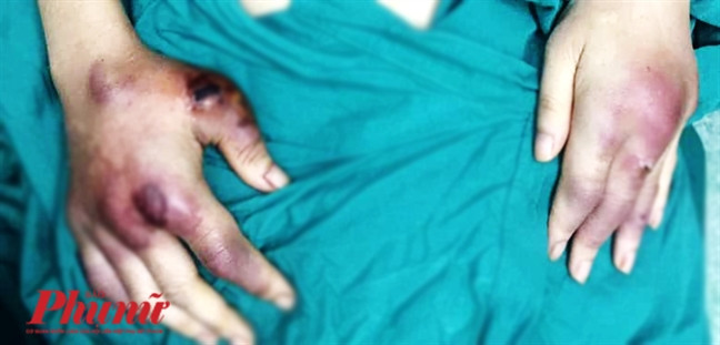 Tranh thủ làm đẹp cuối năm, 2 phụ nữ phải nhập viện để cắt bỏ phần ngực bị hoại tử Tranh thu lam dep cuoi nam, 2 phu nu phai nhap vien de cat bo phan nguc bi hoai tu