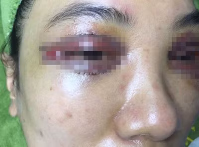 Bệnh nhân gặp sự cố nghiêm trọng sau phẫu thuật thẩm mỹ vùng mắt.