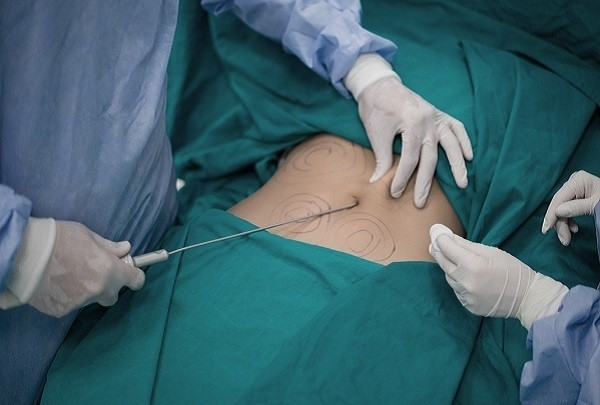 Người đàn ông tử vong khi hút mỡ bụng: Tại sao hút mỡ có thể gây chết người? ảnh 1 Người đàn ông tử vong khi hút mỡ bụng: Tại sao hút mỡ có thể gây chết người? ảnh 1