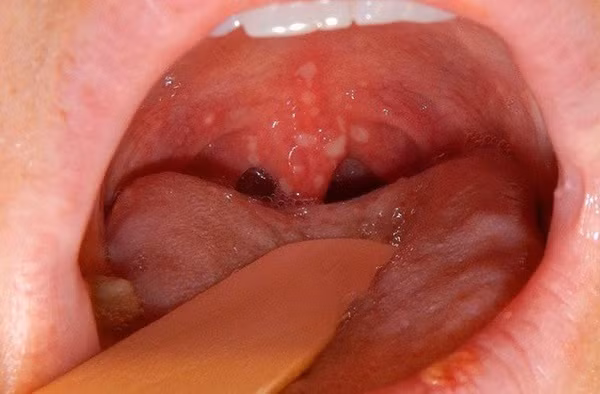 Ung thư vòm họng có liên quan đến virus EBV. .