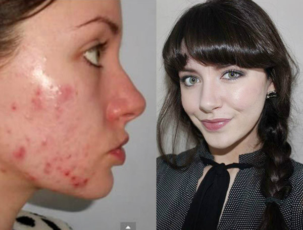 Kỹ năng trang điểm che mụn “thần thánh” khó tin ảnh 7