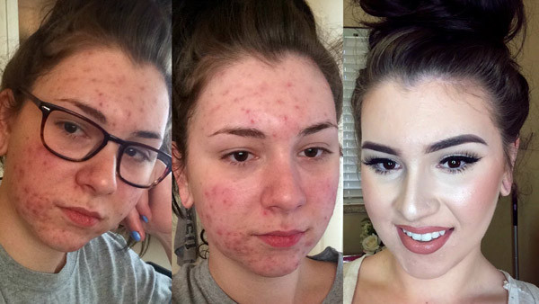 Kỹ năng trang điểm che mụn “thần thánh” khó tin ảnh 10