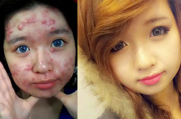 Kỹ năng trang điểm che mụn “thần thánh” khó tin ảnh 5