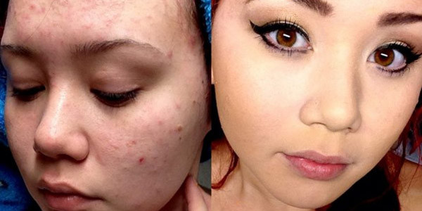 Kỹ năng trang điểm che mụn “thần thánh” khó tin ảnh 2
