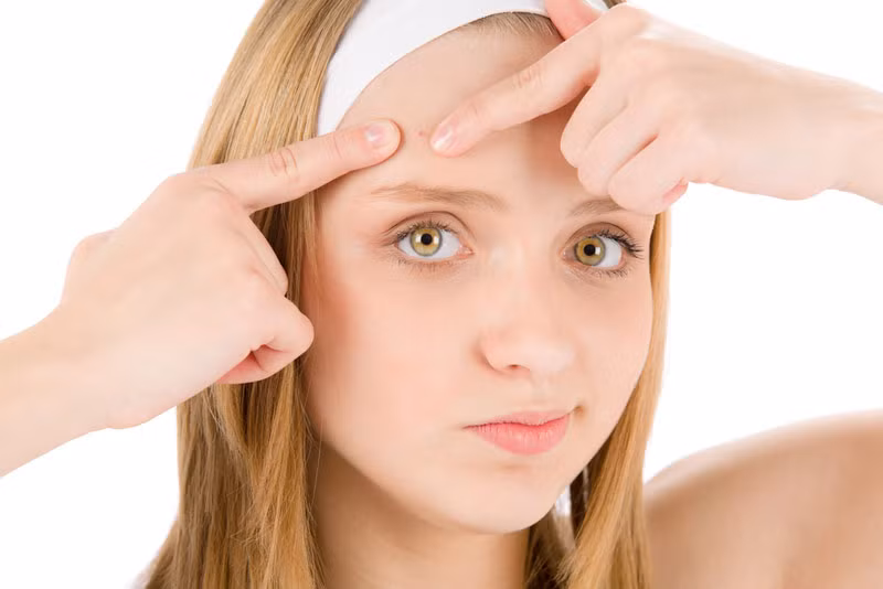 Mách bạn cách trị mụn trứng cá ở tuổi dậy thì nhanh khỏi nhất ảnh 1