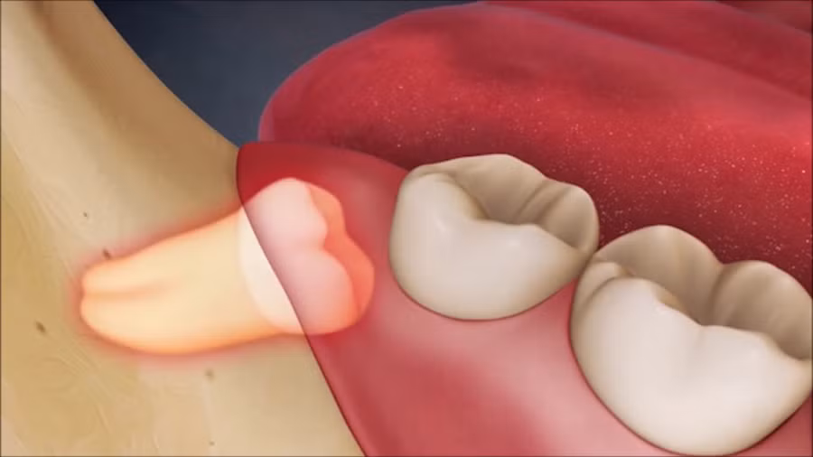 Vị trí của răng số 8 và hình ảnh mọc lệch thường gặp.