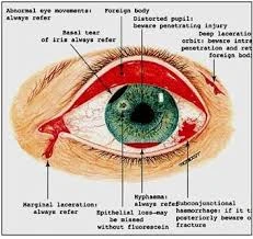 Xuất huyết dưới kết mạc có nguy hiểm?
