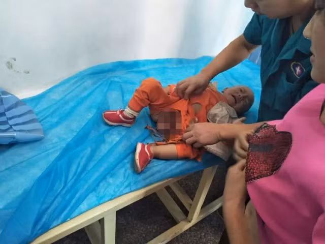 Bé trai dưới 2 tuổi bị kẹt bộ phận sinh dục ở thang cuốn siêu thị - Hình 3