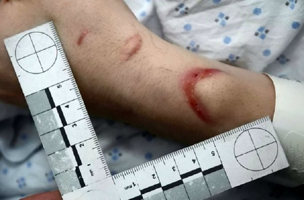 Người đàn ông bị vị hôn thê bạo hành suýt chết ảnh 2 Người đàn ông bị vị hôn thê bạo hành suýt chết ảnh 2