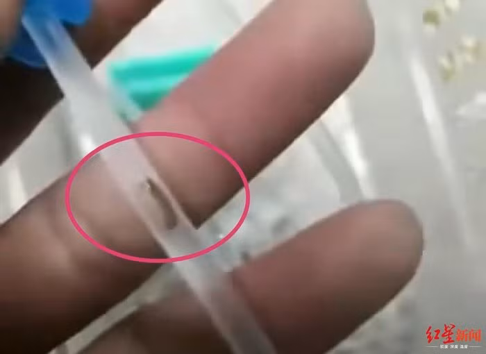 Dị vật giống con sâu bên trong ống truyền dịch.